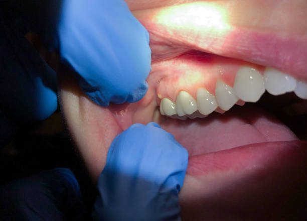 Best Emergency Root Canal Treatment in Stamford, CT